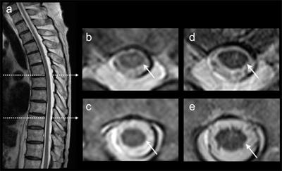 A Patient With Encephalomyeloradiculoneuropathy Exhibiting a Relapsing–Remitting Clinical Course: Correlation of Serum and Cerebrospinal Fluid Anti-Neutral Glycosphingolipids Antibodies With Clinical Relapse